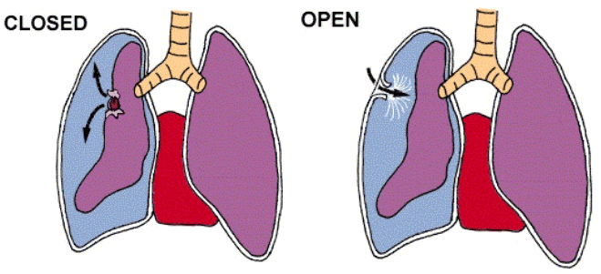 Flail chest, pneumothorax, tension pneumothorax and chest drains. – Nursing  101
